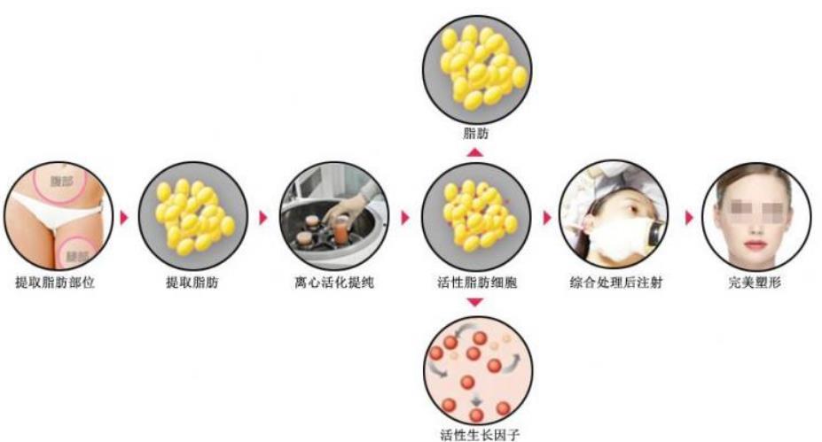 自体脂肪丰脸的优势和缺点盘点，瞬间涨知识