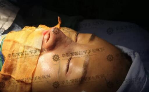塌鼻子的救星来辣|华美紫馨隆鼻3折，你不安排下吗？！