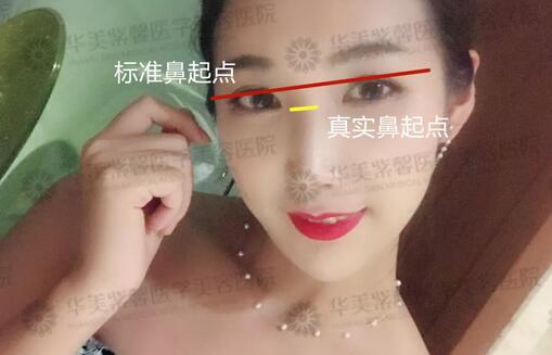 塌鼻子的救星来辣|华美紫馨隆鼻3折，你不安排下吗？！