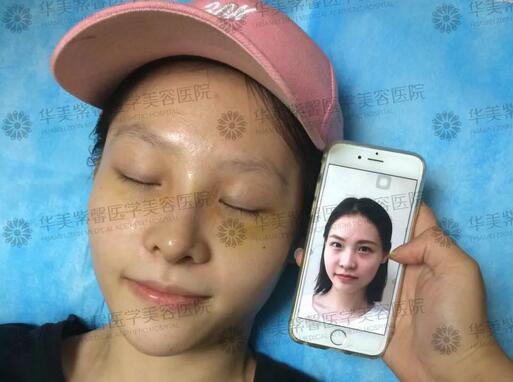 塌鼻子的救星来辣|华美紫馨隆鼻3折，你不安排下吗？！