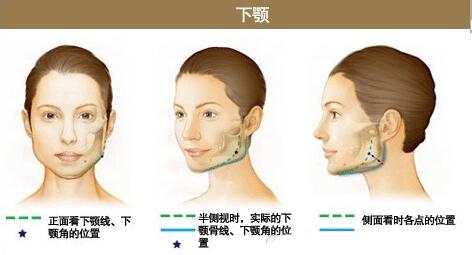 下颌角切除费用多少合理?编哥来给你细说~