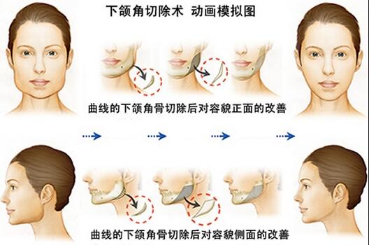 下颌角切除费用多少合理?编哥来给你细说~