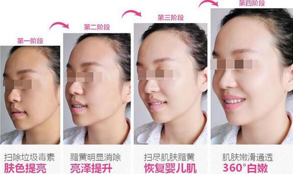 打美白需要多少钱?贵吗?