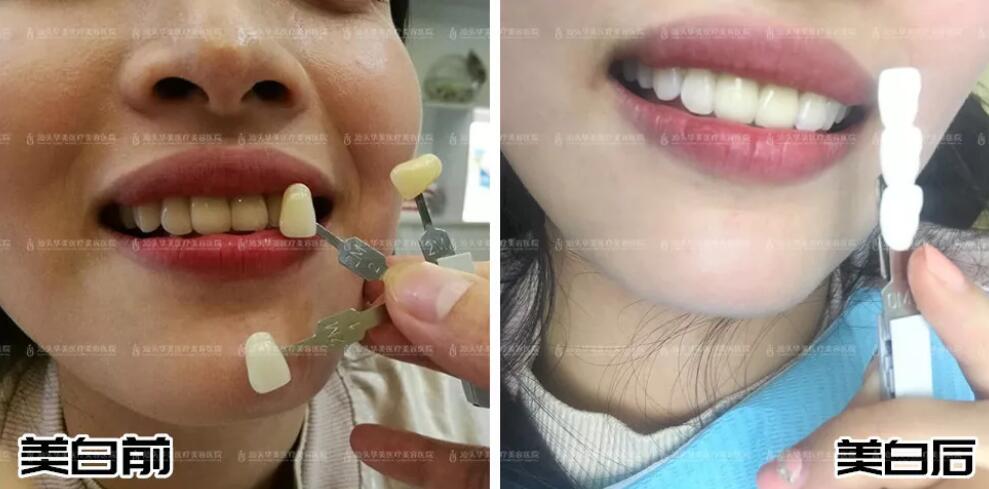 唇红齿白专场丨纹唇、牙齿美白福利来了，放送免费体验名额！