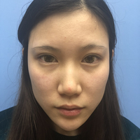 南昌鹏爱整形美容医院怎么样?个人案例为你做较真实的回答