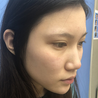 南昌鹏爱整形美容医院怎么样?个人案例为你做较真实的回答