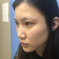 南昌鹏爱整形美容医院怎么样?个人案例为你做较真实的回答