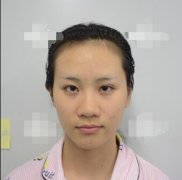 上海美联臣怎么样?【鼻头缩窄108天惊人案例】这样的果我很满意 width=