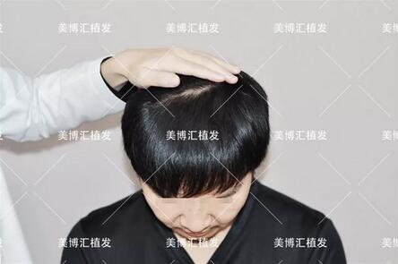 fut植发技术厉害吗？来看看这则案例！