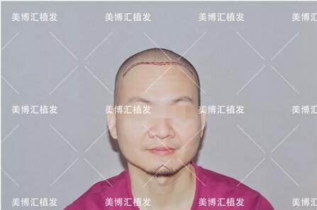 fut植发技术厉害吗？来看看这则案例！