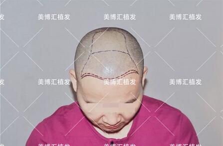 fut植发技术厉害吗？来看看这则案例！