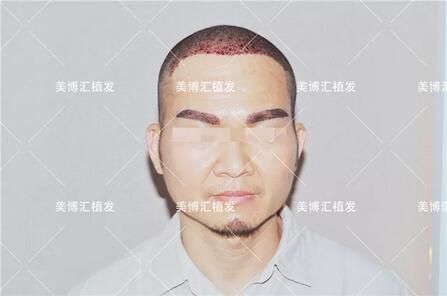fut植发技术厉害吗？来看看这则案例！