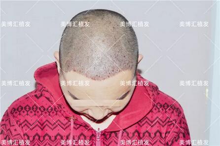 fut植发技术厉害吗？来看看这则案例！