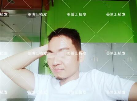 fut植发技术厉害吗？来看看这则案例！