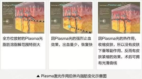 镭射溶脂