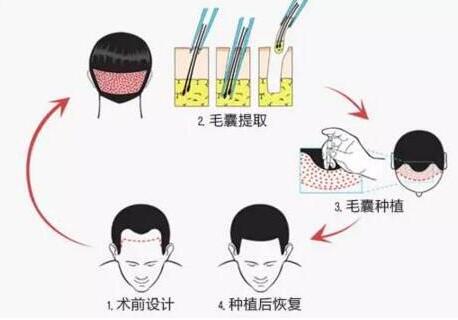 人工植发多少钱?听说有点贵~