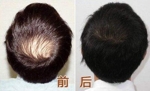 人工植发多少钱?听说有点贵~