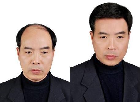 人工植发多少钱?听说有点贵~
