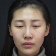范巨峰重睑失败修复案例：20天，解救眼睛被毁的深渊女子! width=