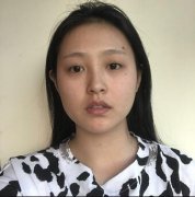 沧州美神6mm切开双眼皮果刚刚好，48天亲身恢复分享~ width=