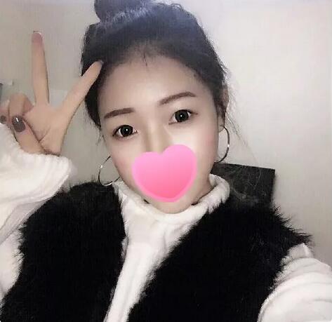 上海薇琳医美张怀军割双眼皮技术好吗？案例就是******见证！
