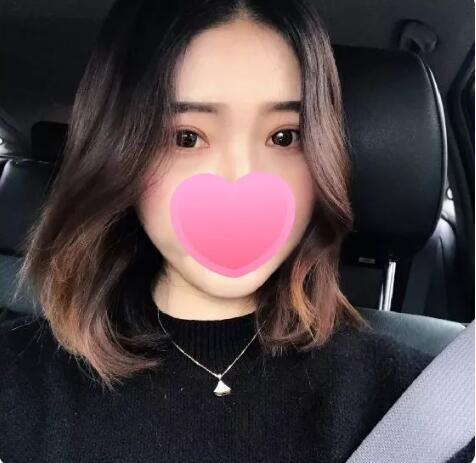 上海薇琳医美张怀军割双眼皮技术好吗？案例就是******见证！