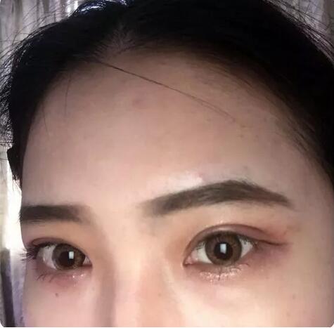 上海薇琳医美张怀军割双眼皮技术好吗？案例就是******见证！