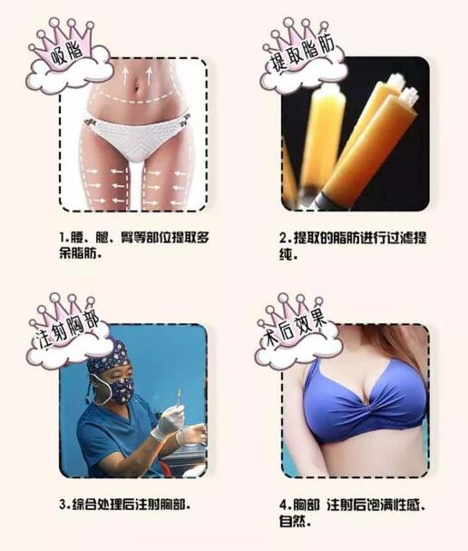 圣嘉新自体脂肪丰胸免费预约