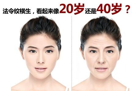 广州海峡整形美容：法令纹误打奥美定后该怎么办？