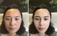 果酸换肤果图，果酸换肤果好吗? width=