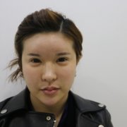 双眼皮专家张润伟是否徒有虚名?张润伟真实案例曝光~ width=