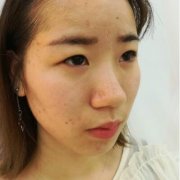 陈焕然在哪家医院?运城切开双眼皮真人体验恢复案例 width=
