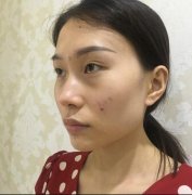 石家庄美联臣韩式小翘鼻63天对比案例 width=