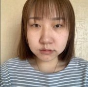 【杜大夫整形韩式翘睫双眼皮案例】1-34天的真实变化~ width=