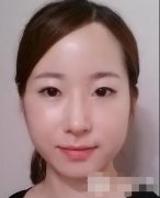 萍乡丽芙整形医院去颊脂垫1-55天的对比变化案例~ width=