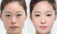 肥胖下颌角整形没问题性有保障吗? width=