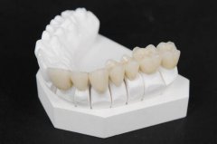 美容冠牙齿矫正果咋样? width=