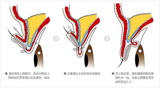 生物焊接双眼皮多少钱?想着周末去做~