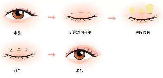 生物焊接双眼皮多少钱?想着周末去做~