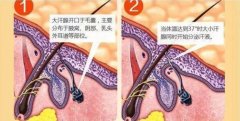 昆明云医大医院腋臭科答：遗传腋臭到了后期还会传染吗？ width=