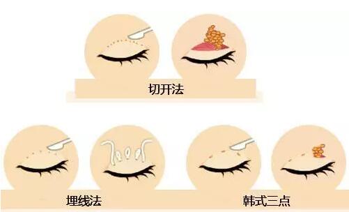 金岛整形徐健割双眼皮怎么样？来看看我的果吧！