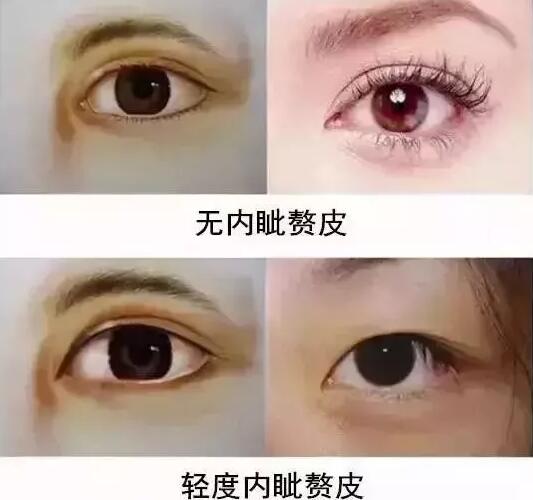 金岛整形徐健割双眼皮怎么样？来看看我的果吧！