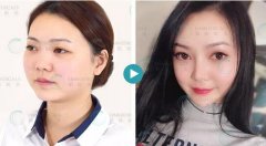 隆鼻假体材料有哪些？到底哪个好？ width=