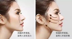 颧骨颧弓整形果怎样？这里有几张对比图~ width=