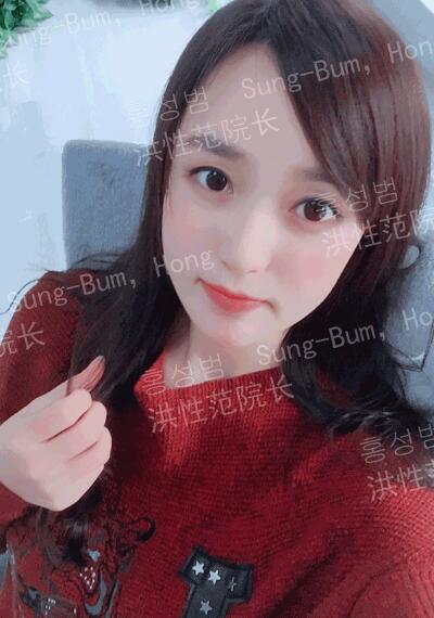 颧骨颧弓整形果怎样？这里有几张对比图~