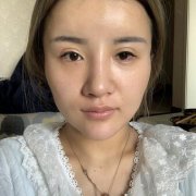 薛旦做脂肪怎么样？薛旦抗老除皱案例很有发言权~ width=