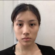 【缩小鼻孔手术对比图案例】73天告别猪胆鼻！ width=
