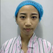 女人后缩下颌角整形对比图：真人案例亲身体验~ width=