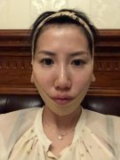 负压冰点脸部皱纹对比图分享：去除面部皱纹都是小case width=