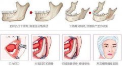 下颌角肥胖整型有后遗症吗? width=